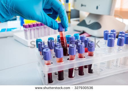 Tổng phân tích tế bào máu chẩn đoán bệnh gì? và hướng dẫn đọc kết quả